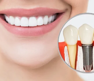 Can Dental Implants Get Infected? What You Need to Know!