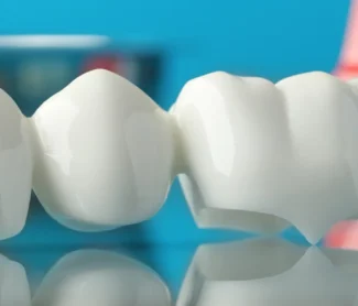 Dental Bridges