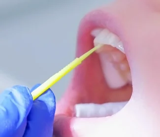 Dental Fillings
