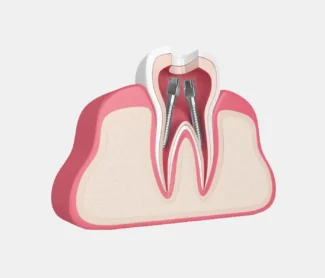 Root Canal Therapy