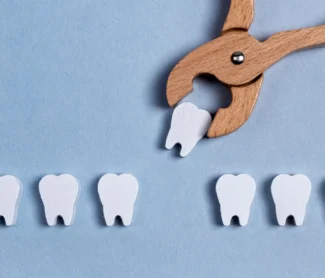 Tooth Extractions