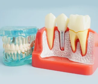 Are Dental Implants Painful? (What to Expect)
