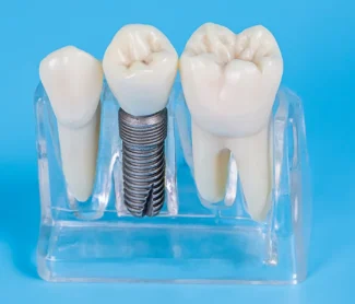 Do Dental Implants Last Forever? What You Need to Know!