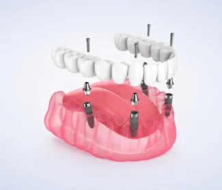 Full Mouth Dental Implants Cost – All You Need to Know!