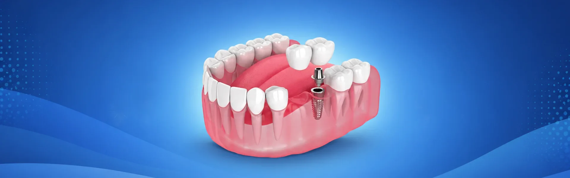 How Much Do Oral Implants Cost? Find Out Here!