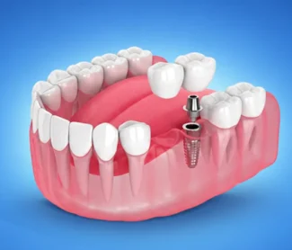 How Much Do Oral Implants Cost? Find Out Here!