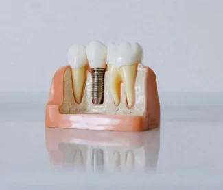 How-do-I-choose-the-best-dental-implant-dentist-in-Carson-CA