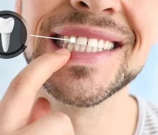 Why Are Dental Implants Expensive? Find Out The Truth!